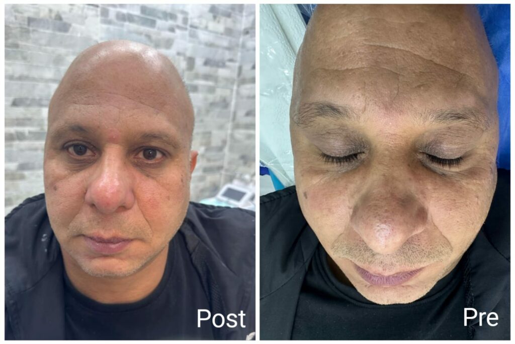 نتائج تنظيف البشرة العميق قبل وبعد